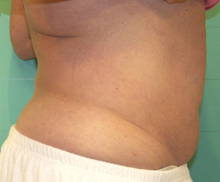 Exilis_B&A_Kacki_belly2_after