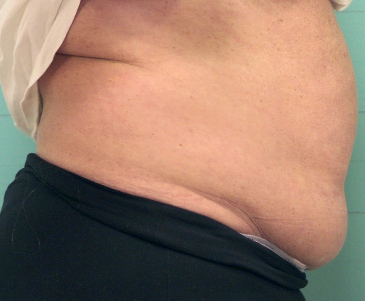 Exilis_B&A_Kacki_belly2_before