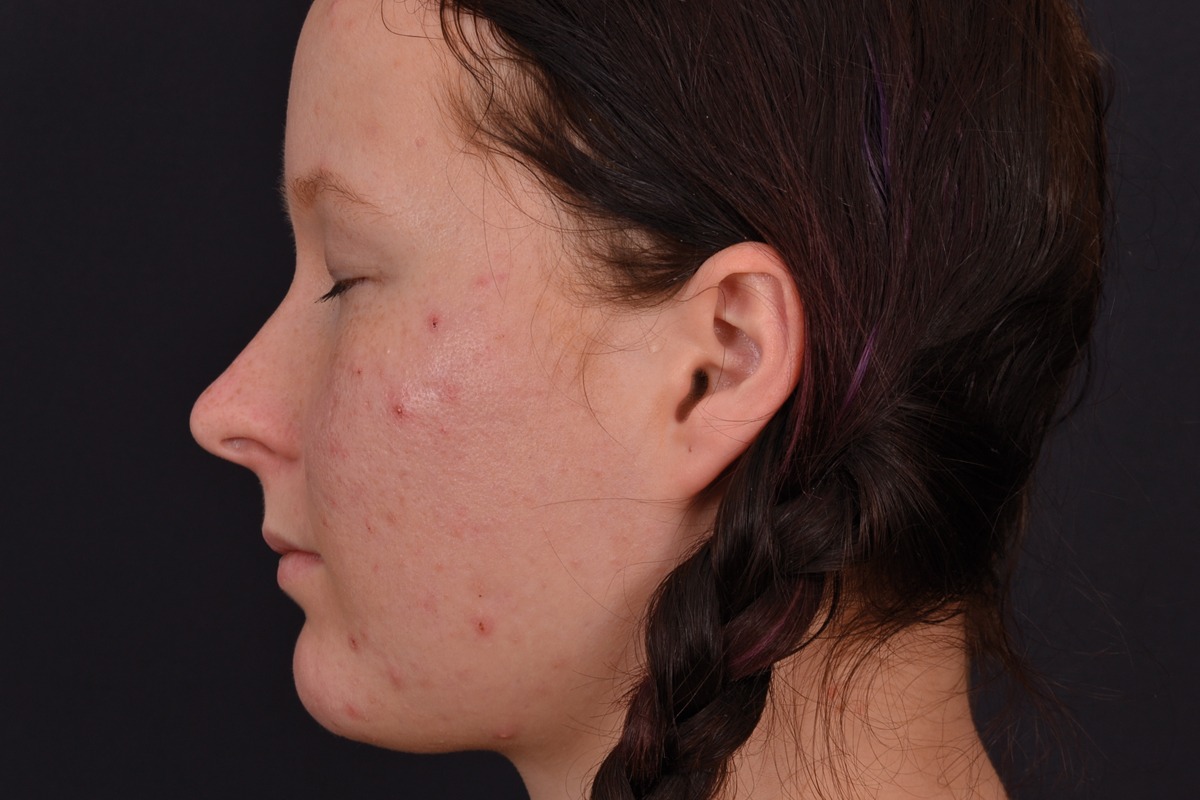 Exilite_Acne_Before