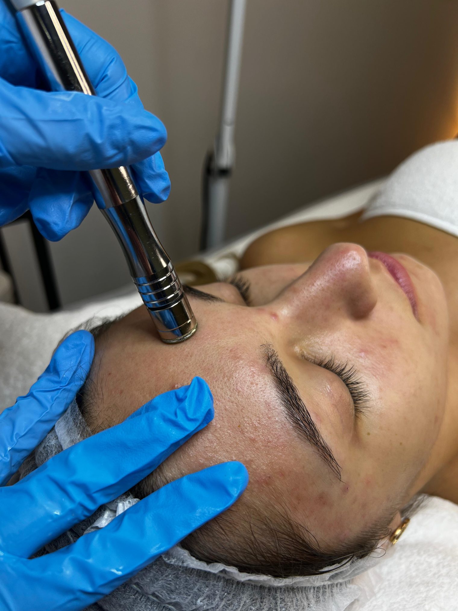 tratament de microdermabraziune in cluj la salon