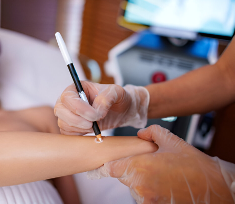 Specialist aplicand creion alb pe o alunita pentru protectie inainte de epilarea definitiva cu laser.