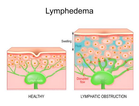 Exemplificare limfedem din punct de vedere histologic