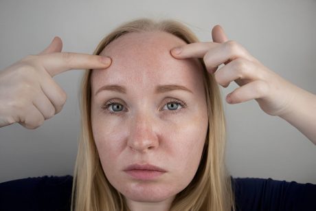 exces de sebum vizibil pe frunte, caracteristica a tenului seboreic