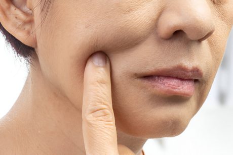 Ten uscat cu zone descuamate si riduri fine in prim plan