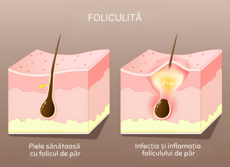 folicul normal vs foliculita